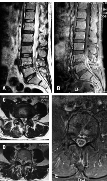 Fig. 1. (A) Preoperative T2-weighted sagittal image shows disc degen- degen-erative changes at L4-5