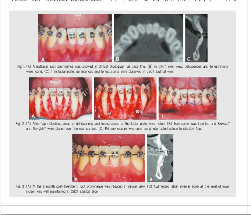 Fig. 2. (A) After flap reflection, areas of dehiscences and fenestrations of the labial plate were noted