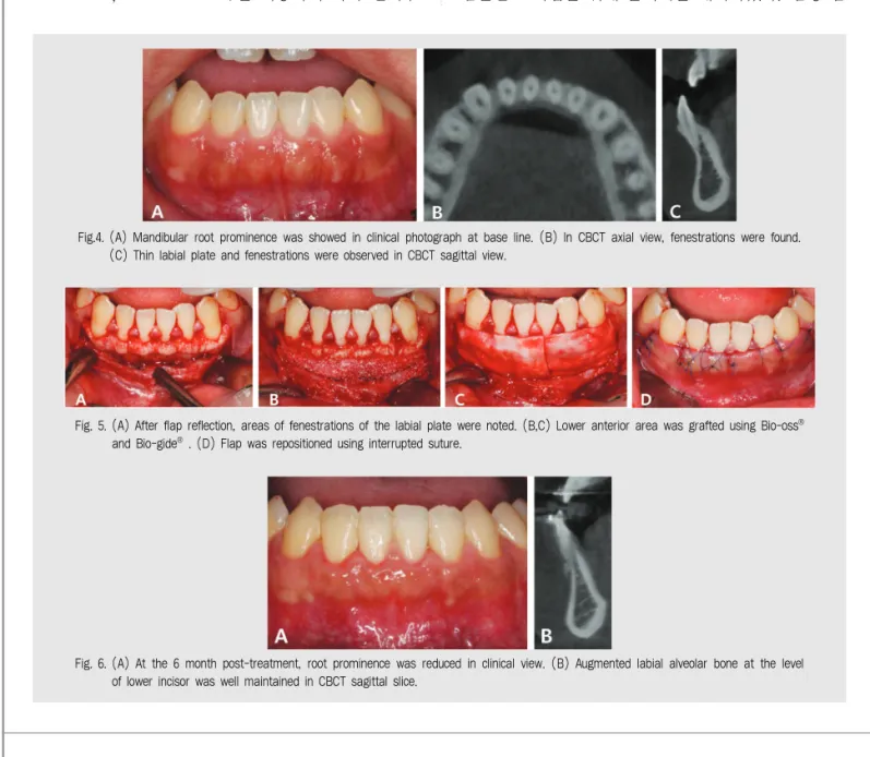 Fig. 5. (A) After flap reflection, areas of fenestrations of the labial plate were noted