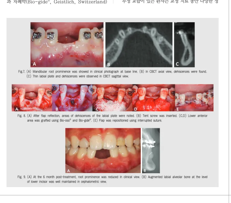 Fig. 8. (A) After flap reflection, areas of dehiscences of the labial plate were noted