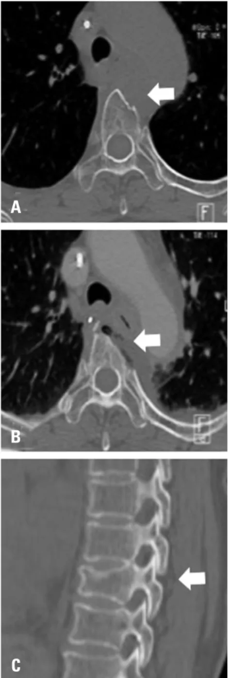 Fig. 3. Computed tomography findings. (A) A pre-operative axial image. 