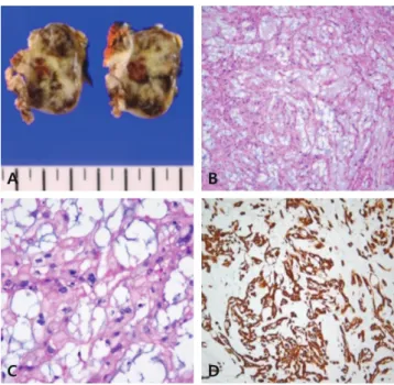 Fig. 5. Computed tomography. (A) An 8-month follow-up axial image. 