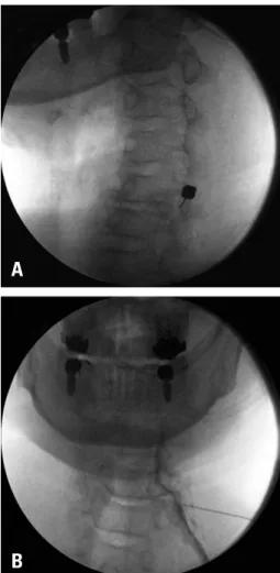 Fig. 3. C-arm images during a cervical transforaminal epidural block of  left C6. (A) Oblique fluoroscopic view