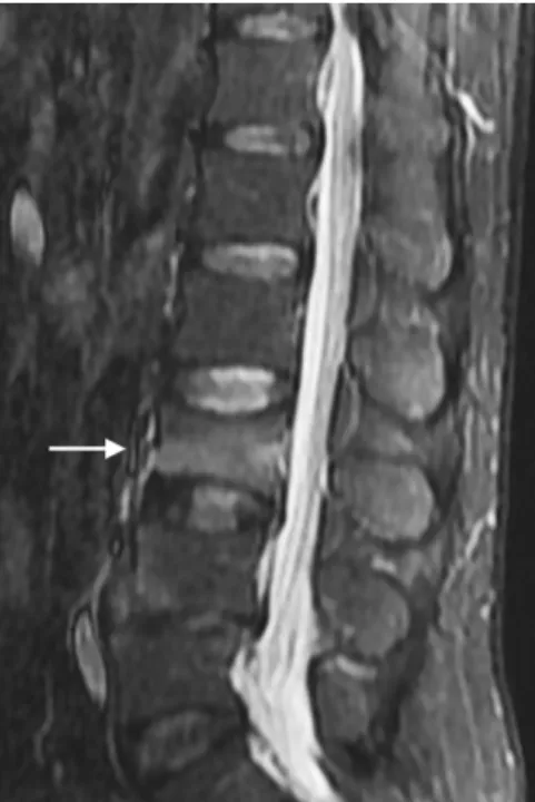 Fig. 6. Computed tomographic scan shows complete bone union of L3 (ar- (ar-row).