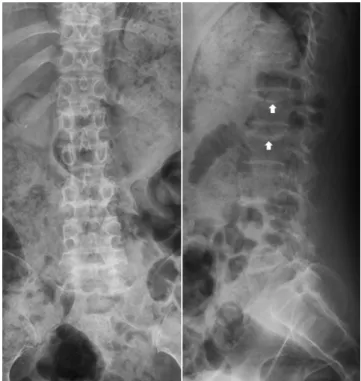 Fig. 1. Initial anteroposterior and lateral view of plain radiographs shows  a concave shape of the upper endplate because of compression fractures  at L1 and L2.