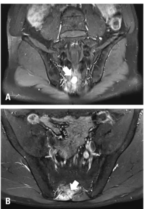 Fig. 2. Bone scintigraphy shows increased uptake in the middle of the  second sacral vertebra (S2) (arrows)
