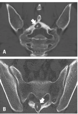 Fig. 5. The surgically excised specimen shows ventral bulging of the os- os-teoid osteoma (arrows) as seen on the computed tomography image (Fig  4B).