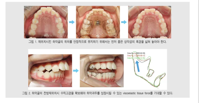 그림 2. 하악골의 전방재위치시 수직고경을 확보해야 하악과두를 성장시킬 수 있는 viscoelastic tissue force를 기대할 수 있다.