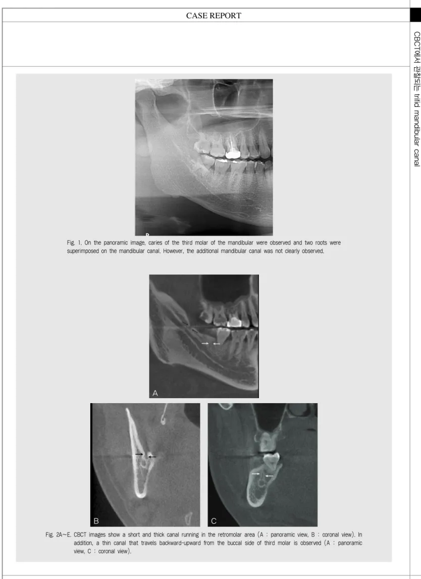 Fig. 1. On the panoramic image, caries of the third molar of the mandibular were observed and two roots were superimposed on the mandibular canal