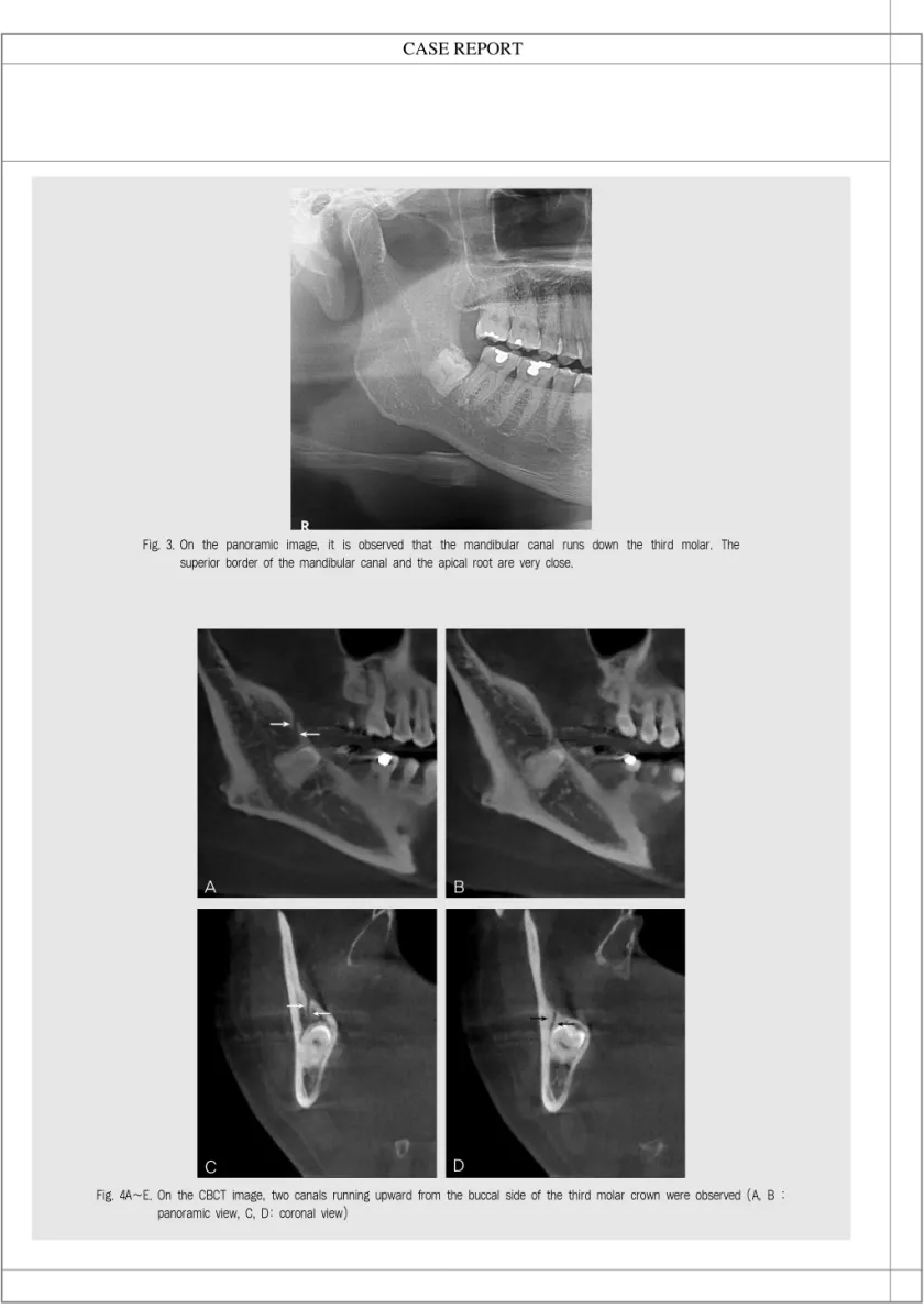 Fig. 3. On  the  panoramic  image,  it  is  observed  that  the  mandibular  canal  runs  down  the  third  molar