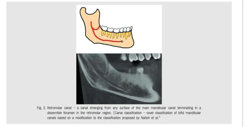Fig. 5. Retromolar canal - a canal emerging from any surface of the main mandibular canal terminating in a discernible foramen in the retromolar region