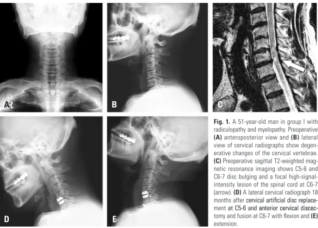 Fig. 1. A 51-year-old man in group I with  radiculopathy and myelopathy. Preoperative  (A) anteroposterior view and (B) lateral  view of cervical radiographs show  degen-erative changes of the cervical vertebrae