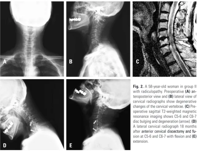 Fig. 2. A 58-year-old woman in group II  with radiculopathy. Preoperative (A) an- an-teroposterior view and (B) lateral view of  cervical radiographs show degenerative  changes of the cervical vertebrae