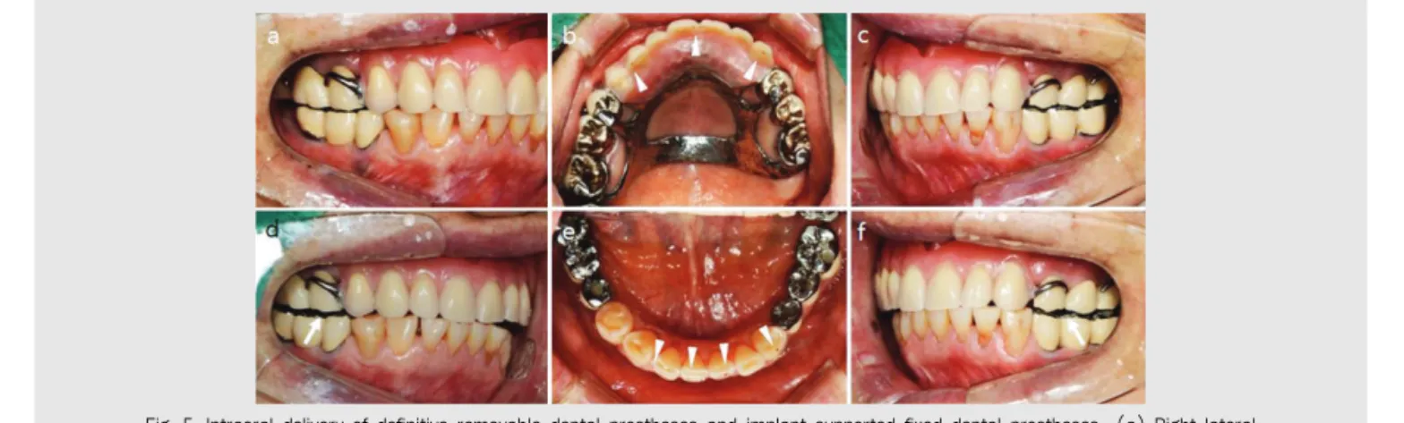 Fig. 5. Intraoral delivery of definitive removable dental prostheses and implant-supported fixed dental prostheses  (a) Right lateral view