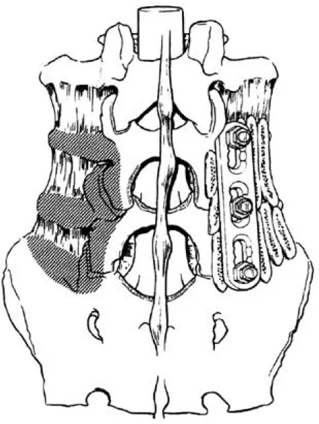 Fig. 1. Posterolateral fusion.