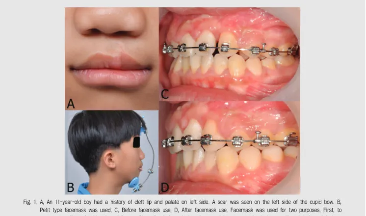 Fig. 1. A, An 11-year-old boy had a history of cleft lip and palate on left side. A scar was seen on the left side of the cupid bow