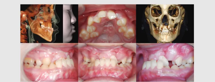 Fig. 3. Pretreatment photographs of an 11-year-old boy with a history of cleft lip and palate on the left side