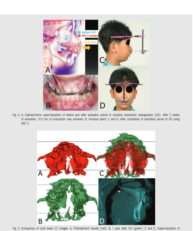 Fig. 4. A, Cephalometric superimposition of before and after activation period of maxillary distraction osteogenesis (DO)