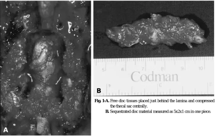 Fig. 1-A. Free disc tissues placed just behind the lamina and compressed the thecal sac centrally.