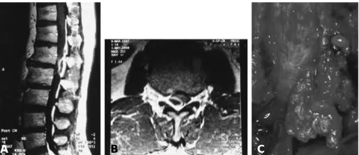 Fig. 2-A. Enhanced T1 weighted sagittal image demonstrate free disc material surrounded by granulation tissues(peripheral halo) at the L1-2 level.