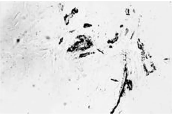 Fig 1. Low magnification view of herniation disc tissue show- show-ing granulation tissue with blood vessels.