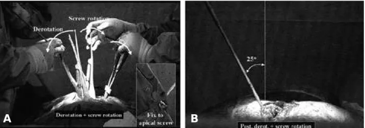 Fig. 2. Derotation-screw rotation maneuver(A). During the derotation(counter-clockwise) of the rod, rotate the derotators which were fixed to the screws into the opposite direction(clockwise)(B)