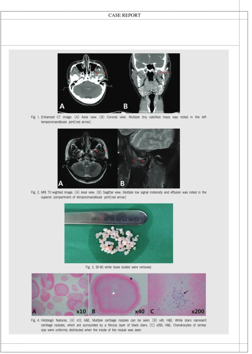 Fig. 1. Enhanced  CT  image.  (A)  Axial  view.  (B)  Coronal  view.  Multiple  tiny  calcified  mass  was  noted  in  the  left temporomandibular joint(red arrow).