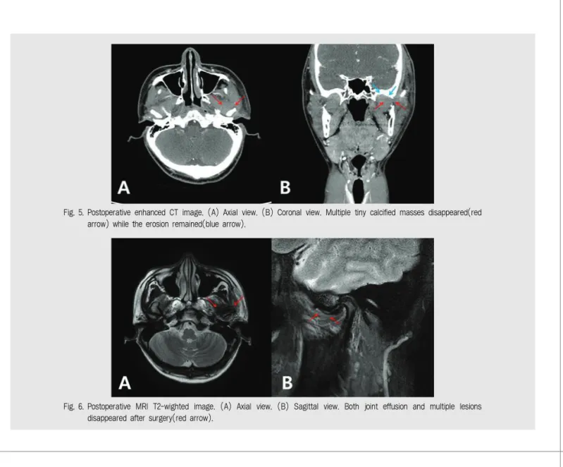 Fig. 5. Postoperative enhanced CT image. (A) Axial view. (B) Coronal view. Multiple tiny calcified masses disappeared(red arrow) while the erosion remained(blue arrow).