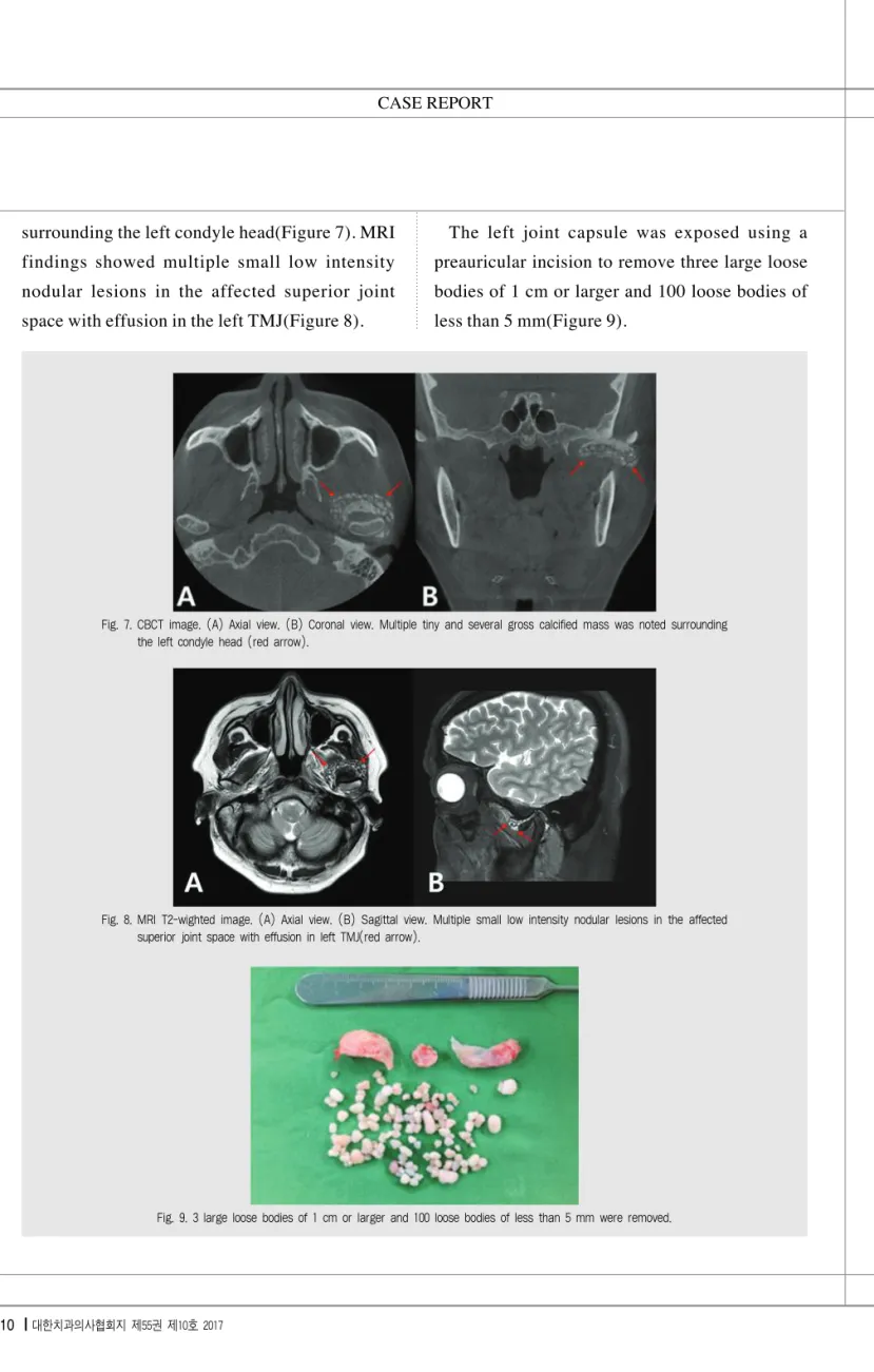 Fig. 7. CBCT image. (A) Axial view. (B) Coronal view. Multiple tiny and several gross calcified mass was noted surrounding the left condyle head (red arrow).