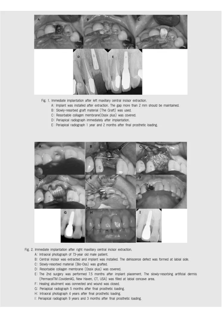 Fig. 1. Immediate implantation after left maxillary central incisor extraction.