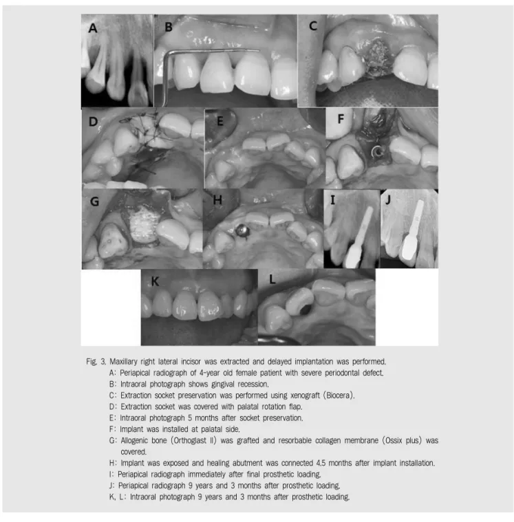 Fig. 3. Maxillary right lateral incisor was extracted and delayed implantation was performed.