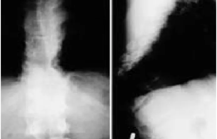 Fig. 1. 35-year-old male paient Initial radiograph showed acute angular kyphosis due to tuberculous spondylitis with 85 degree kyphotic angle