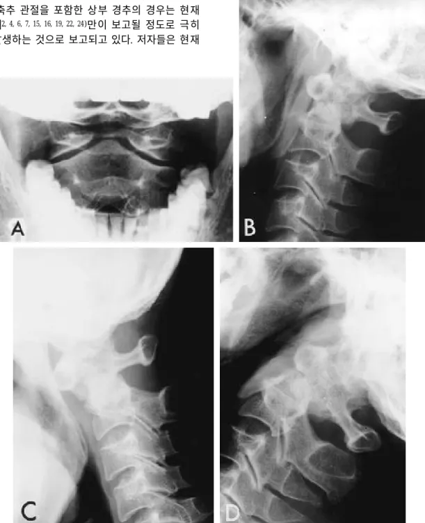 Fig. 1. A and B, Open mouth view and lateral radiograph of the cervical spine showing a small, round ossicle located above the C1-C2 facet joints with a wide gap between ossicle and axis body