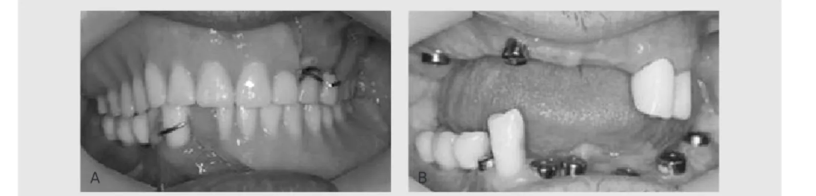 Fig. 1. Intraoral view at first visit. (a) Frontal view with interim denture, (b) without interim denture.