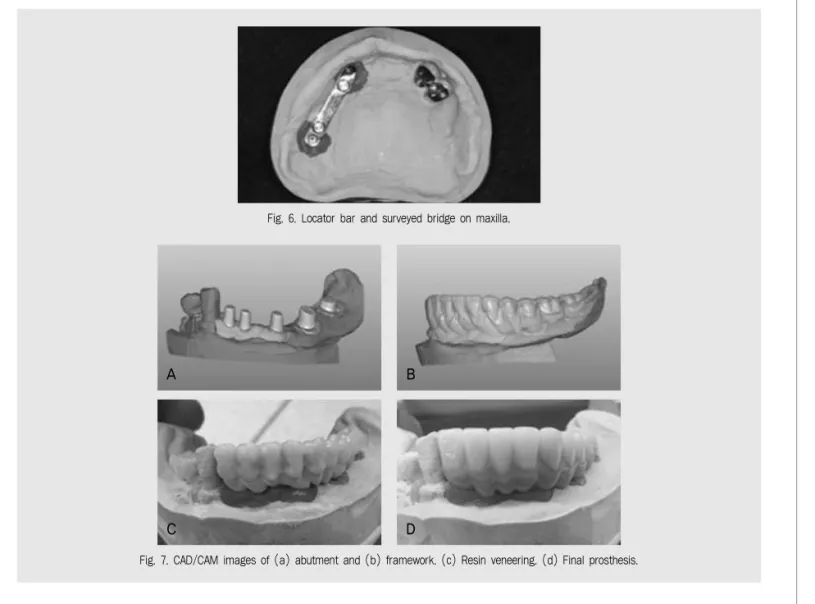 Fig. 6. Locator bar and surveyed bridge on maxilla.