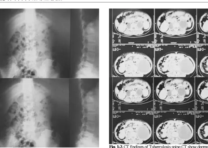 Fig. 1-2. CT findings of Tuberculosis spine CT show degree of bony destruction and extension of cold abscess.