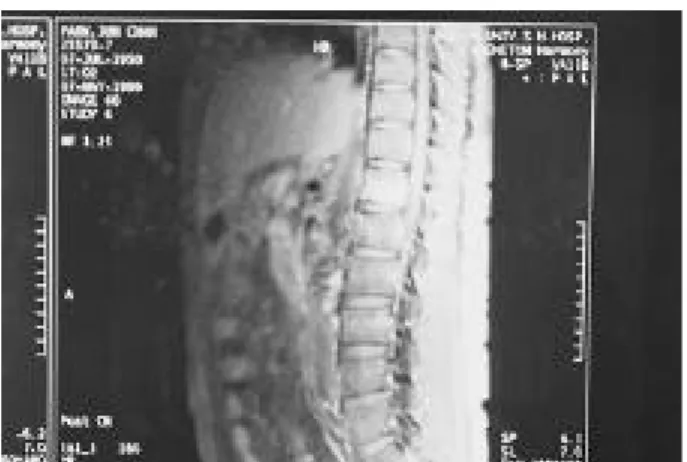 Fig. 2-5. MRI of Tuberculosis spine (coronal view). MRI show changes of intensity to center of T12  interver-tebral body.