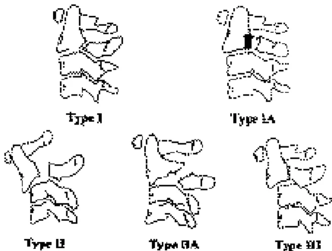 Fig. 6. Classification of traumatic spondylolisthesis of the axis.