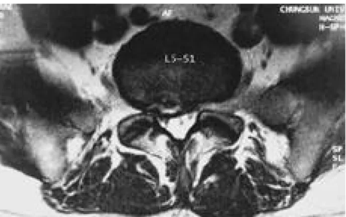Fig. 4. Protruded disc and spinal stenosis of right lateral recess at L5-S1 level.