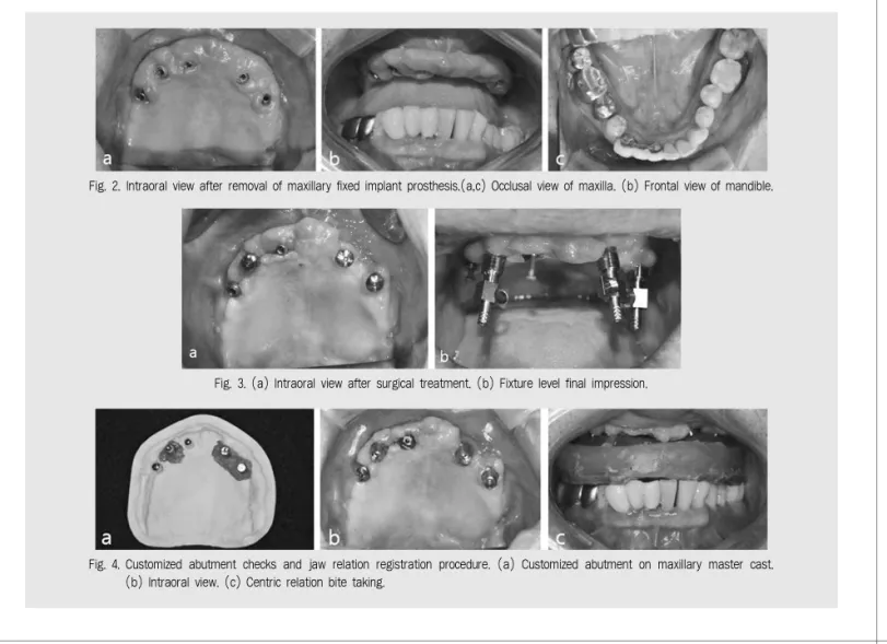 Fig. 2. Intraoral view after removal of maxillary fixed implant prosthesis.(a,c) Occlusal view of maxilla