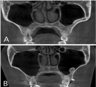 Fig. 2. Examples  of  exostoses  consisted  of  compact  bone  with  broad  base(A)  and  exostoses  consisted  of compact and spongy bone with pedunculated base(B)