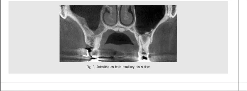 Fig. 3. Antroliths on both maxillary sinus floor