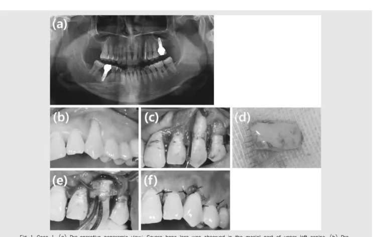 Fig. 1. Case 1. (a) Pre-operative panoramic view: Severe bone loss was observed in the mesial part of upper left canine