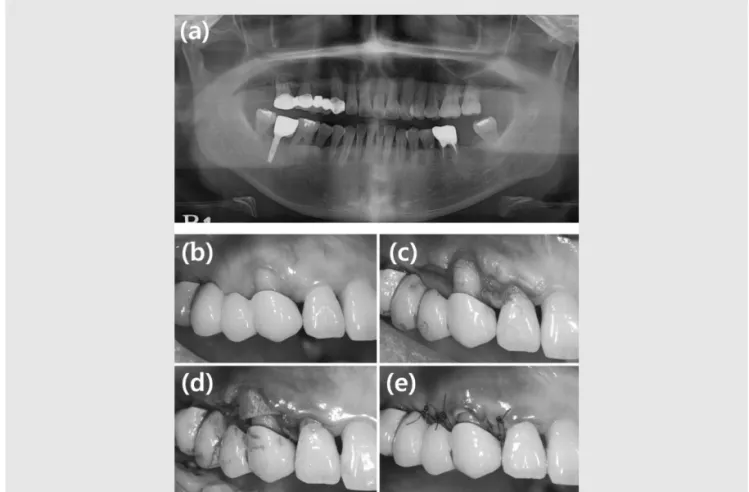 Fig. 3. Case 2. (a) Pre-operative panoramic view (b) Pre-operative clinical view. (c) Full thickness flap incision line