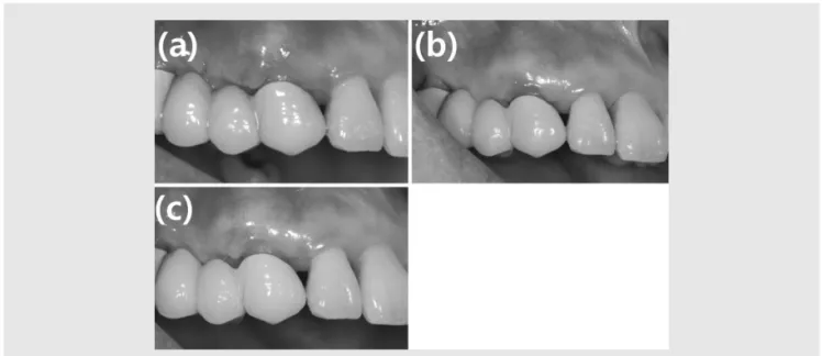 Fig. 4. Case 2. (a) Post-operative clinical view: 2 weeks after stitch-out. (b) Post-operative clinical view: 3 months after