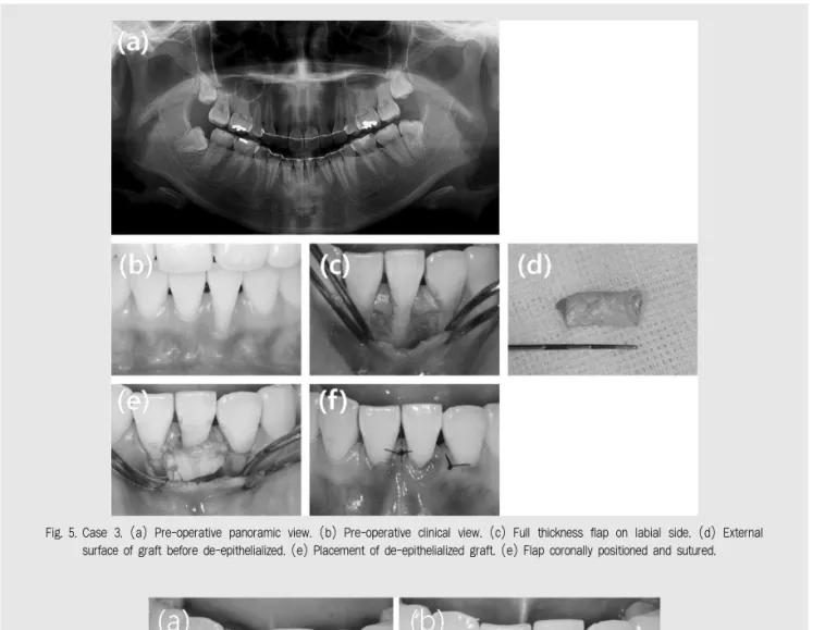 Fig. 5. Case 3. (a) Pre-operative panoramic view. (b) Pre-operative clinical view. (c) Full thickness flap on labial side