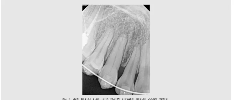 Fig. 1. 술전 방사선 사진: #13 근심측 치간골의 약간의 소실이 관찰됨. 