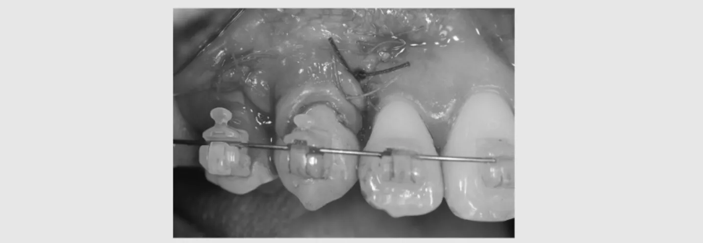 Fig. 3. 수술 직후 임상사진 : free gingival graft 를 동반한 coronally advanced flap 을 시행함.