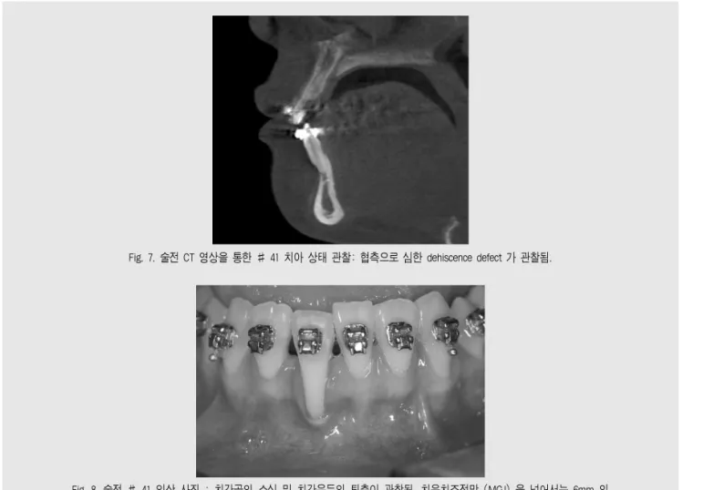 Fig. 7. 술전 CT 영상을 통한 # 41 치아 상태 관찰: 협측으로 심한 dehiscence defect 가 관찰됨.