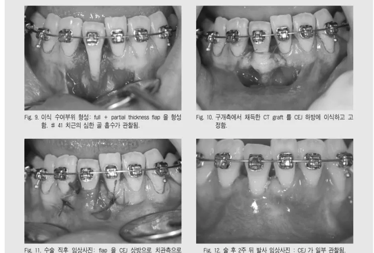 Fig. 9. 이식 수여부위 형성: full + partial thickness flap 을 형성 함. # 41 치근의 심한 골 흡수가 관찰됨.   